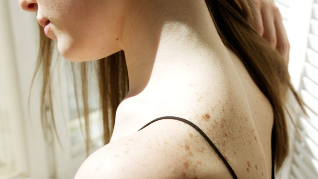 Cáncer de piel: aprenda a prevenir, diagnosticar y tratar