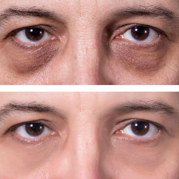 Preenchimento de olheiras: Antes e Depois e valor com ácido hialurônico -  BeautVip